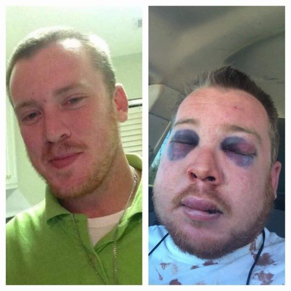 Billy Johnson before and after the attack (Source: Johnson family)