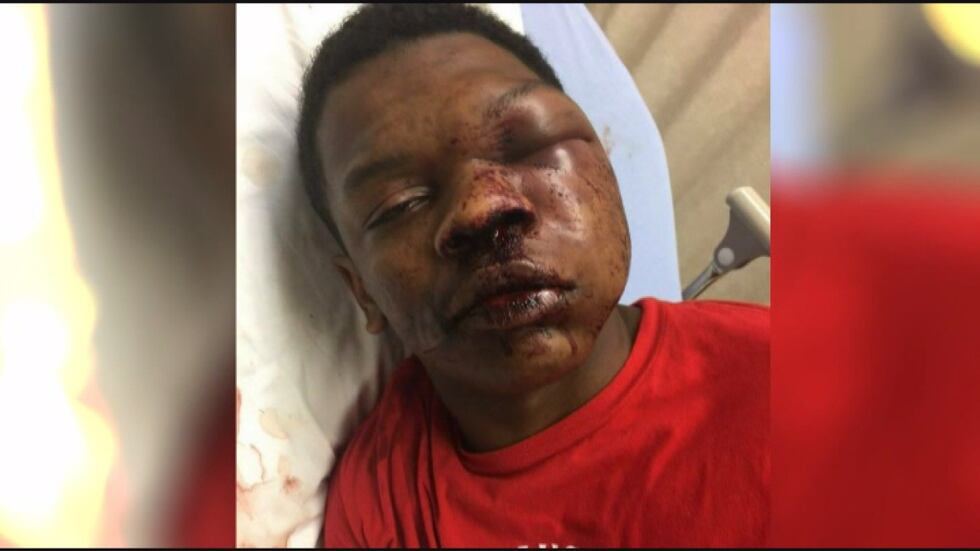 According to CNN, Wilkerson's father said his son had brain swelling and a cracked eye socket....